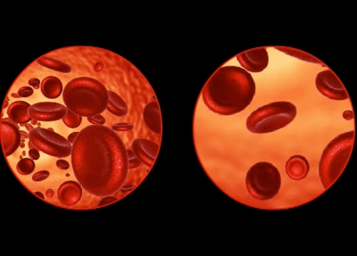 Anemia during pregnancy