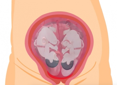 जुड़वा बच्चों के साथ योनि प्रसव संभव है? Is vaginal delivery possible with twins