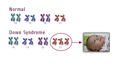 Test for Downs syndrome