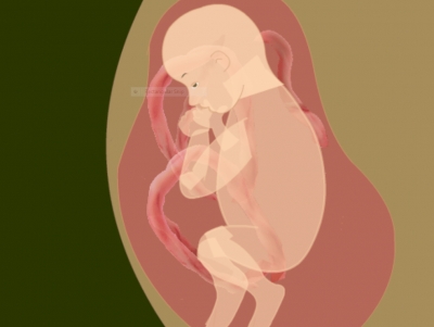 What is Polyhydramnios ( Excess amniotic fluid)?