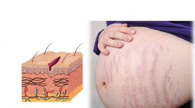 गर्भावस्ता के दौरान खिंचाव के निशान (Stretch Marks During Pregnancy)