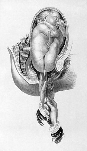 Breech presentation and vaginal delivery