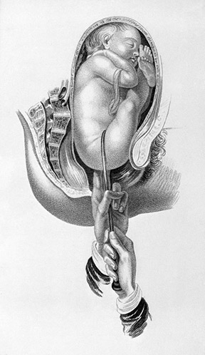 Breech presentation and vaginal delivery