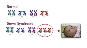 डाउन सिंड्रोम के लिए टेस्ट