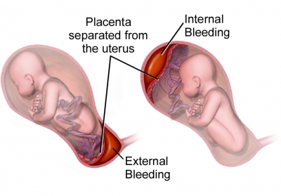 Should we be worried about bleeding during the second trimester?