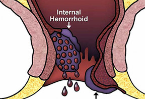 Hemorrhoids during pregnancy