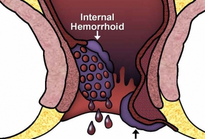 Hemorrhoids during pregnancy